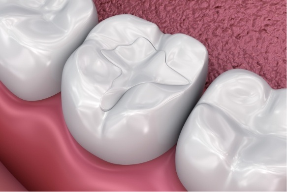 Animated smile with dental sealants