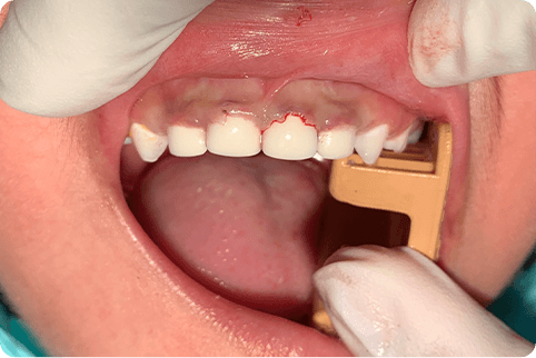 Smile after upper teeth are replaced