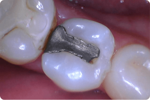 Smile with metal fillings