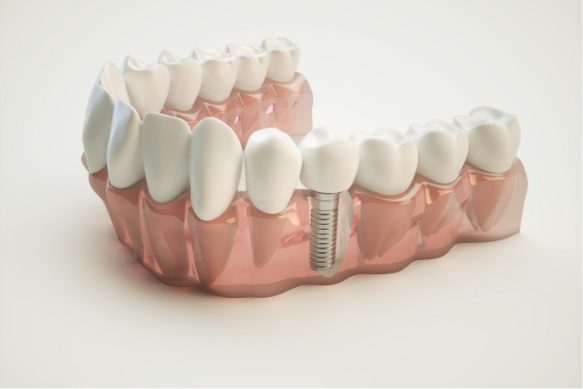 Animated smile with dental implant supported dental crown