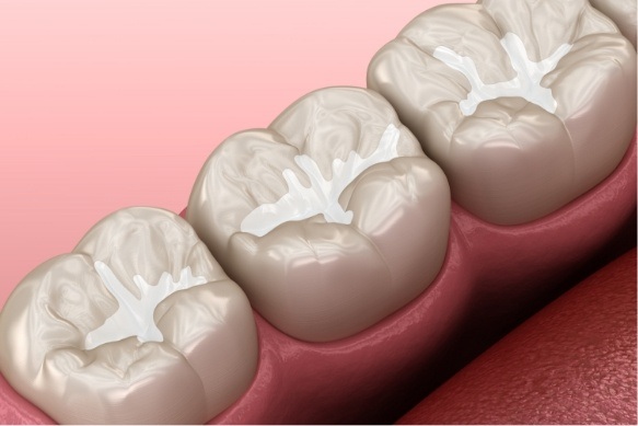 Animated smile with tooth colored fillings