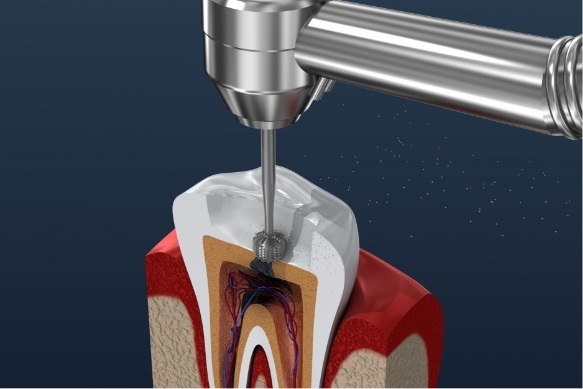Animated smile during root canal treatment